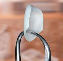 A porcelain veneer held up with a dental tool