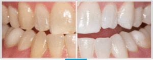Boost Whitening Before and After