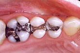 sample of patient with silver fillings