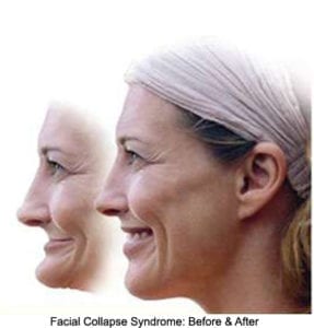 A woman both with and without facial collapse