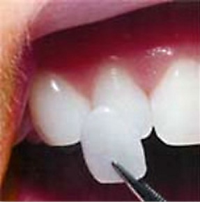 a porcelain veneer being placed on a tooth