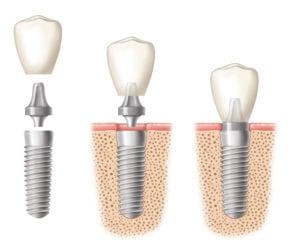 Image of a dental implant being placed in three stages