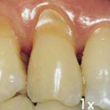 teeth with abfraction lesions