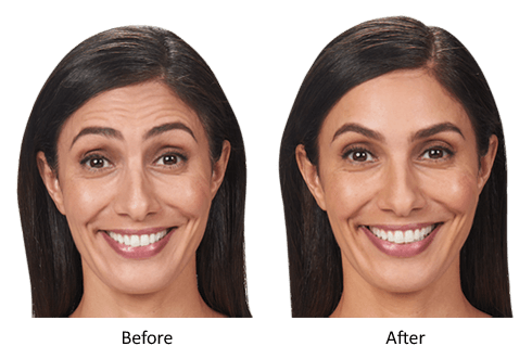 Before-and-after photos of a woman's face treated with Botox. The "after" photo shows no forehead lines and reduced lines under the eyes.