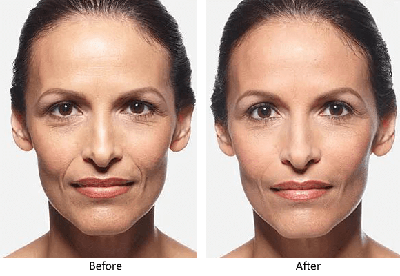 Before-and-after JUVÉDERM® photos. The after photo on the right shows smoother skin with reduced facial lines.facial lines