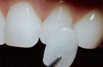 A single porcelain veneer held next to a tooth