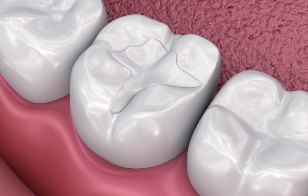 Metal-Free Fillings: What to Know About Today’s Safer-Looking, Tooth-Friendly Options